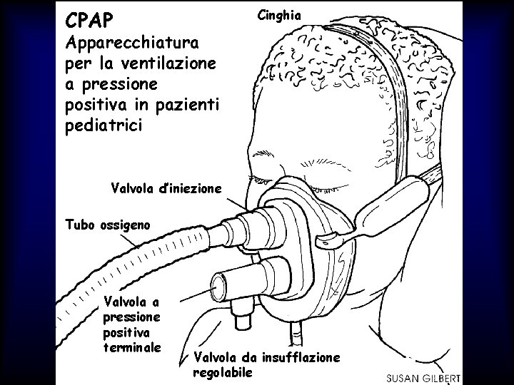 CPAP Cinghia Apparecchiatura per la ventilazione a pressione positiva in pazienti pediatrici Valvola d’iniezione