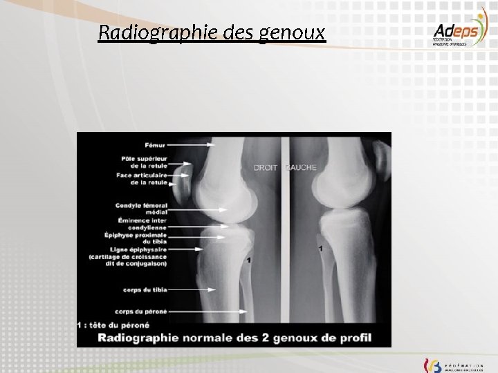 Radiographie des genoux 