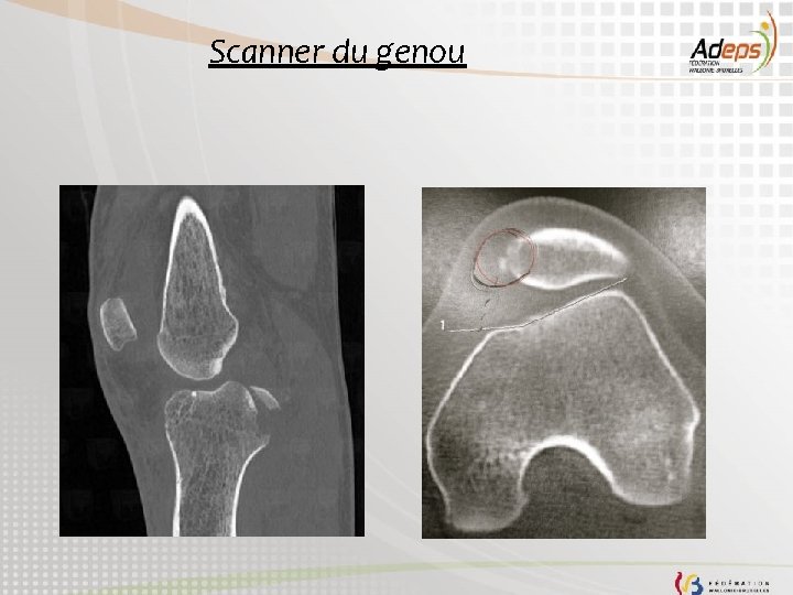 Scanner du genou 