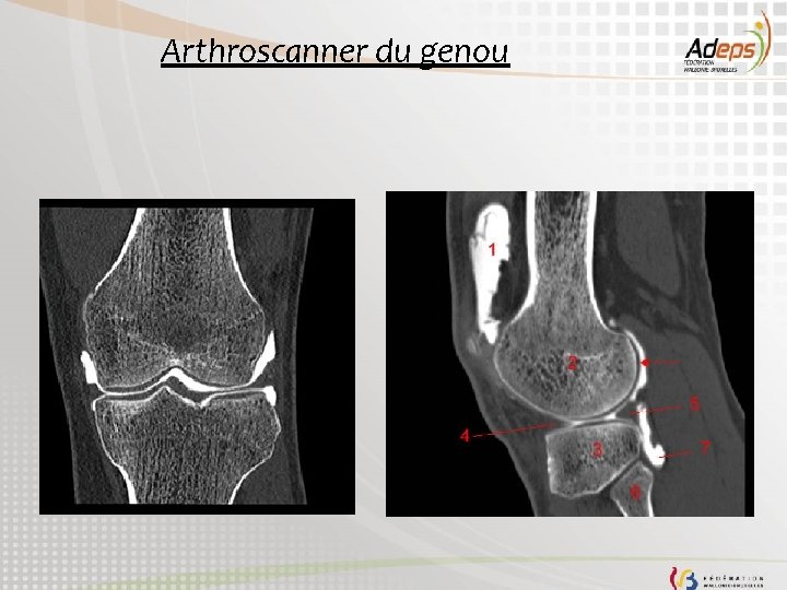 Arthroscanner du genou 