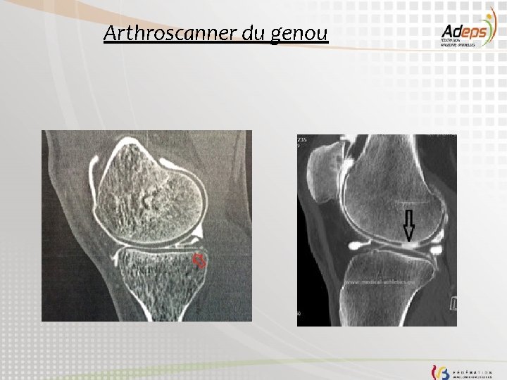 Arthroscanner du genou 