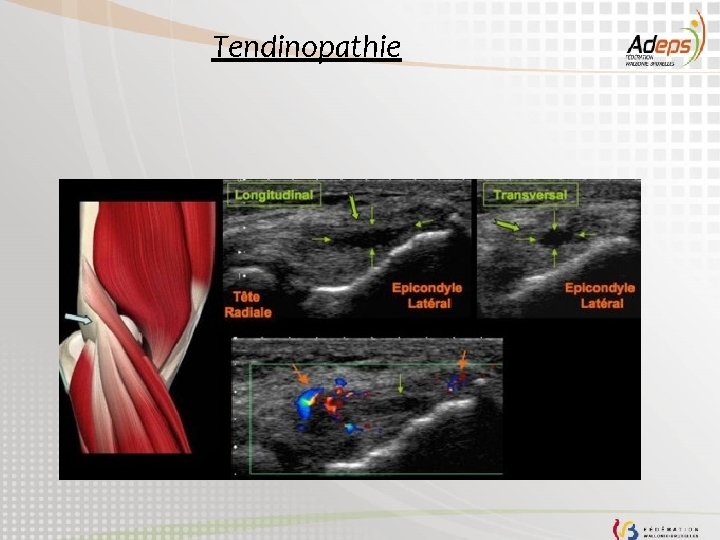 Tendinopathie 