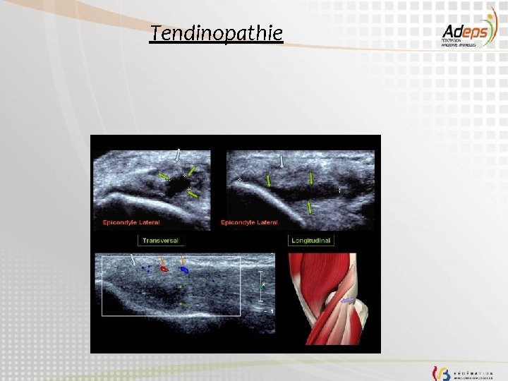 Tendinopathie 