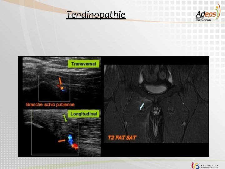 Tendinopathie 