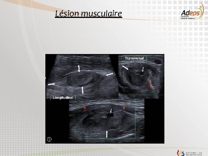 Lésion musculaire 