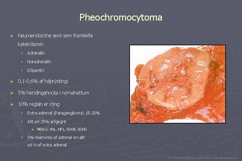 Pheochromocytoma ► Neuroendocrine æxli sem framleiða katekólamín § Adrenalín § Noradrenalín § Dópamín ►