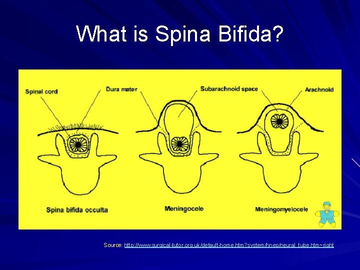 What is Spina Bifida? Source: http: //www. surgical-tutor. org. uk/default-home. htm? system/hnep/neural_tube. htm~right 