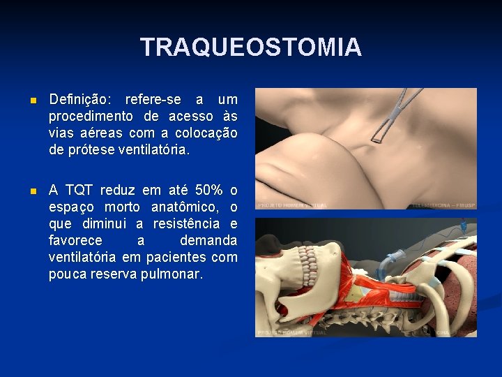 TRAQUEOSTOMIA n Definição: refere-se a um procedimento de acesso às vias aéreas com a
