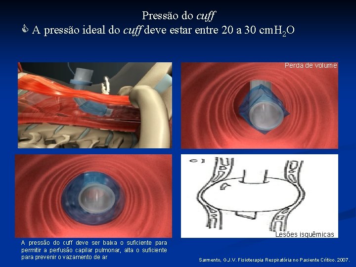 Pressão do cuff A pressão ideal do cuff deve estar entre 20 a 30