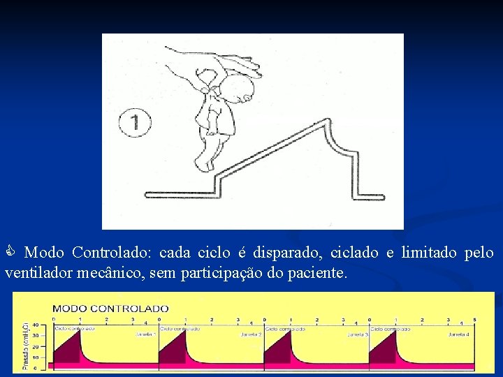  Modo Controlado: cada ciclo é disparado, ciclado e limitado pelo ventilador mecânico, sem