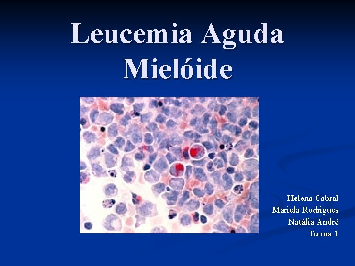 Leucemia Aguda Mielóide Helena Cabral Mariela Rodrigues Natália André Turma 1 