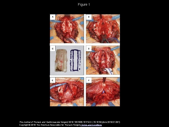 Figure 1 The Journal of Thoracic and Cardiovascular Surgery 2016 1521008 -1017 DOI: (10.