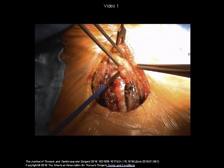 Video 1 The Journal of Thoracic and Cardiovascular Surgery 2016 1521008 -1017 DOI: (10.