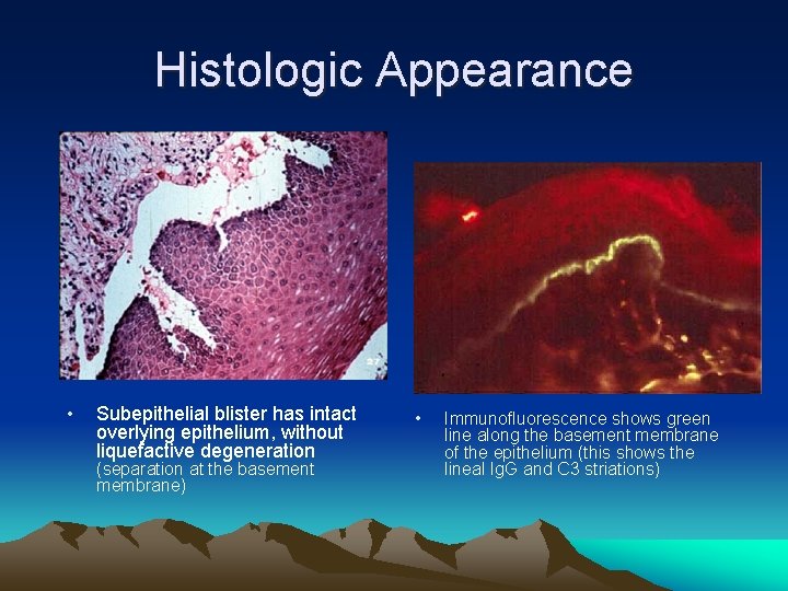 Histologic Appearance • Subepithelial blister has intact overlying epithelium, without liquefactive degeneration (separation at