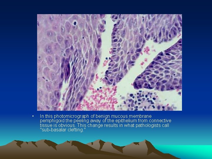  • In this photomicrograph of benign mucous membrane pemphigoid the peeling away of