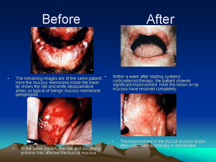 Before The remaining images are of the same patient. • Here the mucous membrane