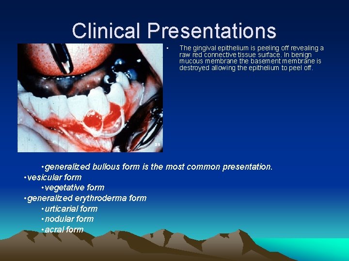 Clinical Presentations • The gingival epithelium is peeling off revealing a raw red connective