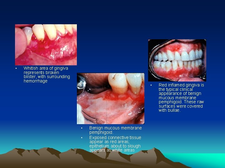  • Whitish area of gingiva represents broken blister, with surrounding hemorrhage • •