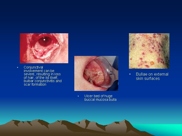 • Conjunctival involvement can be severe, resulting in loss of hair, of the