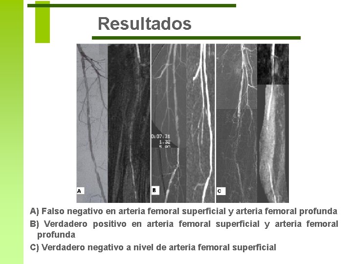 Resultados A) Falso negativo en arteria femoral superficial y arteria femoral profunda B) Verdadero