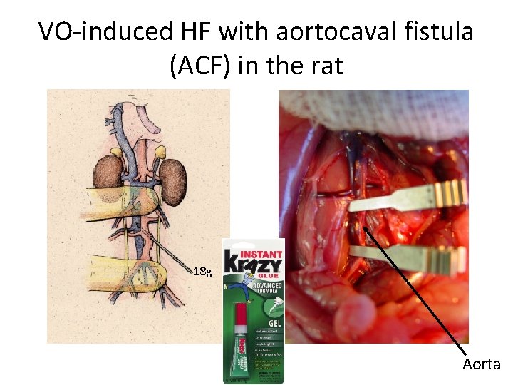 VO-induced HF with aortocaval fistula (ACF) in the rat 18 g Aorta 