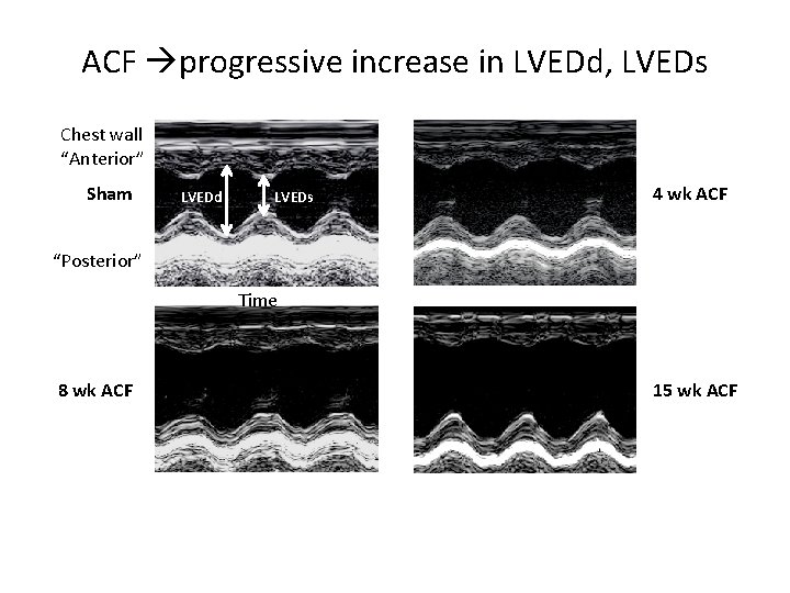 ACF progressive increase in LVEDd, LVEDs Chest wall “Anterior” Sham LVEDd LVEDs 4 wk
