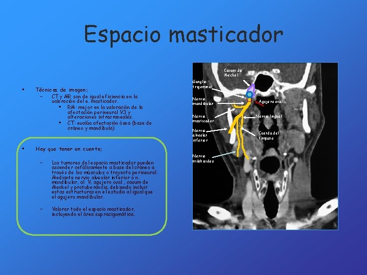 Espacio masticador Cavum de Meckel • • Técnicas de imagen: – CT y MR