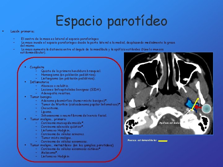  • Lesión primaria: – – – Espacio parotídeo El centro de la masa