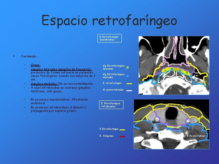 Espacio retrofaríngeo E. Retrofaríngeo Suprahioideo • Contenido: – – – Grasa. Ganglios laterales (ganglios