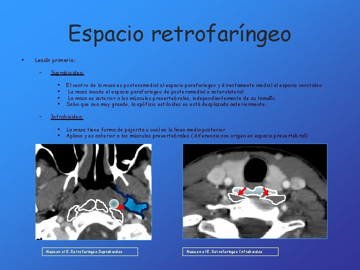 Espacio retrofaríngeo • Lesión primaria: – Suprahioidea: • • – El centro de la