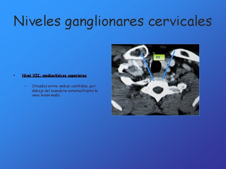 Niveles ganglionares cervicales VII • Nivel VII: mediastínicos superiores – Situados entre ambas carótidas,