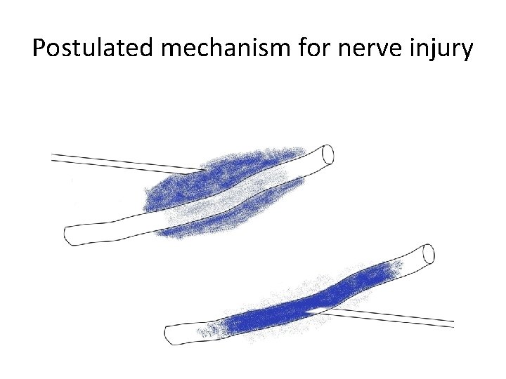 Postulated mechanism for nerve injury 