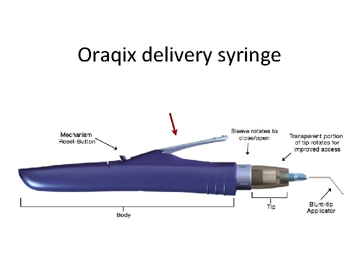 Oraqix delivery syringe 