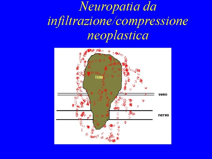 Neuropatia da infiltrazione/compressione neoplastica Neuropatia da infiltrazione/compressione neoplastica
