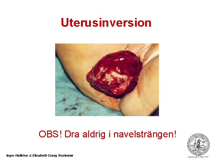 Uterusinversion OBS! Dra aldrig i navelsträngen! Inger Hallsten & Elizabeth Crang Svalenius 