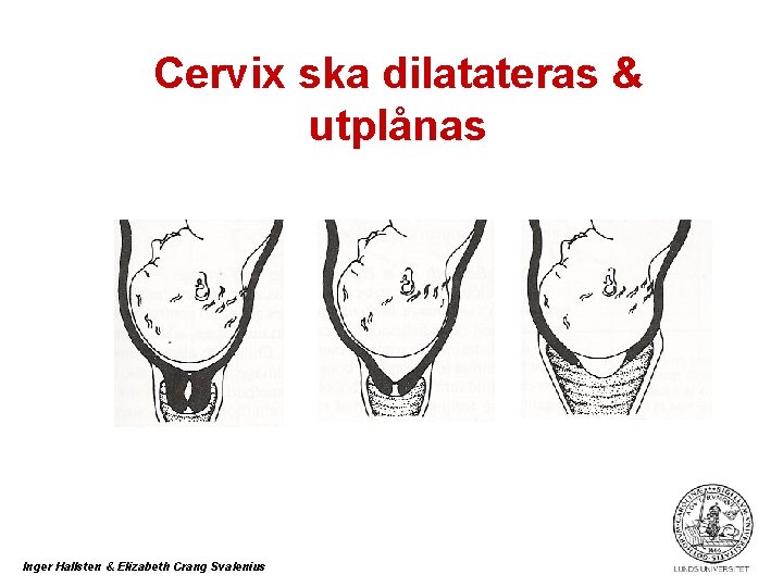 Cervix ska dilatateras & utplånas Inger Hallsten & Elizabeth Crang Svalenius 