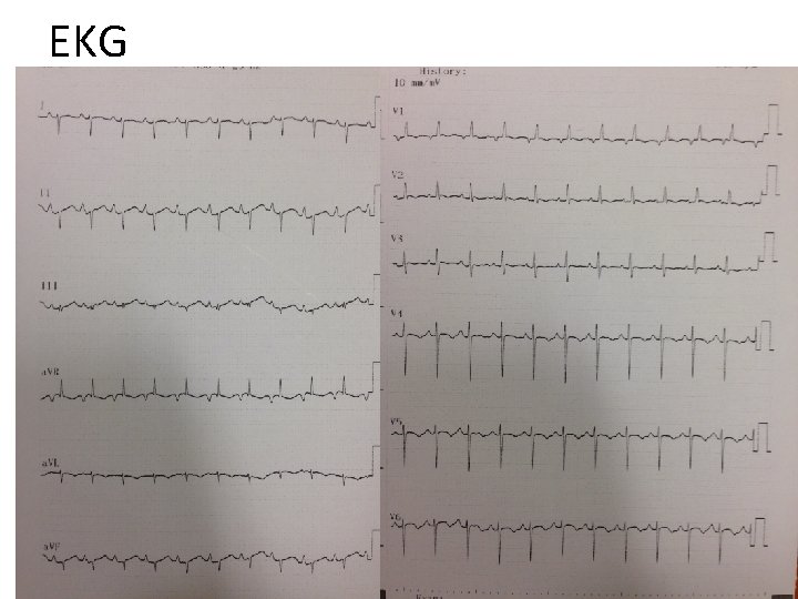 EKG 