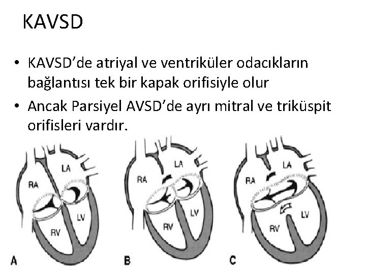 KAVSD • KAVSD’de atriyal ve ventriküler odacıkların bağlantısı tek bir kapak orifisiyle olur •