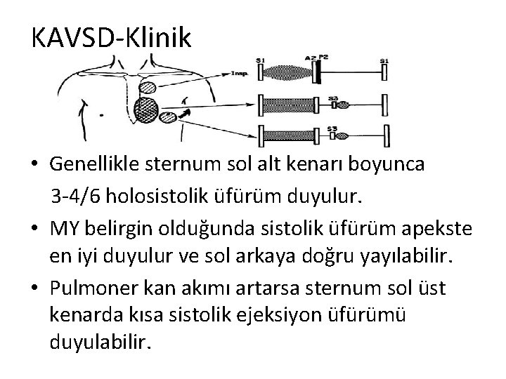 KAVSD-Klinik • Genellikle sternum sol alt kenarı boyunca 3 -4/6 holosistolik üfürüm duyulur. •