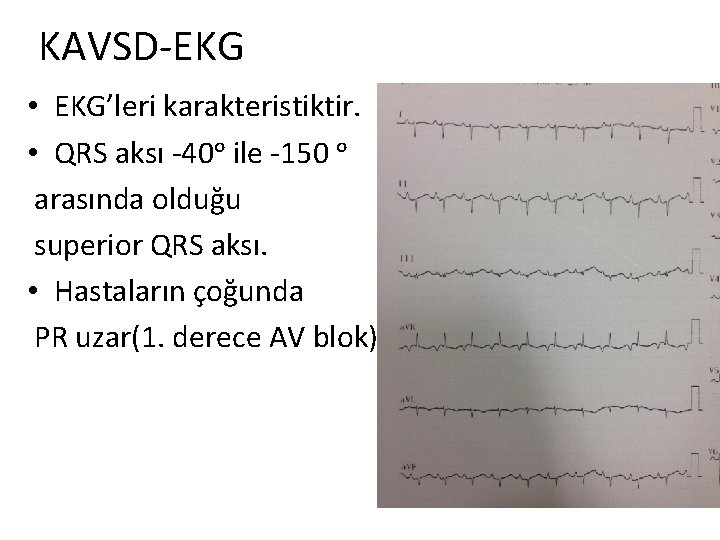 KAVSD-EKG • EKG’leri karakteristiktir. • QRS aksı -40ᵒ ile -150 ᵒ arasında olduğu superior