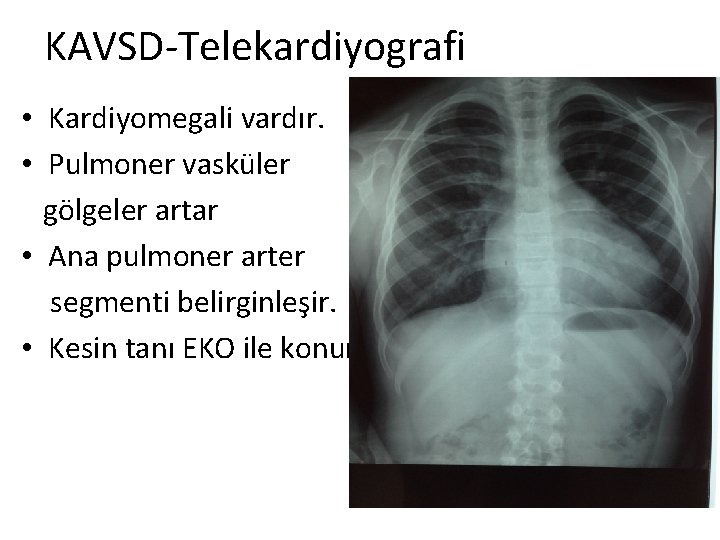 KAVSD-Telekardiyografi • Kardiyomegali vardır. • Pulmoner vasküler gölgeler artar • Ana pulmoner arter segmenti