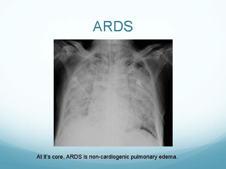 ARDS At it’s core, ARDS is non-cardiogenic pulmonary edema. 