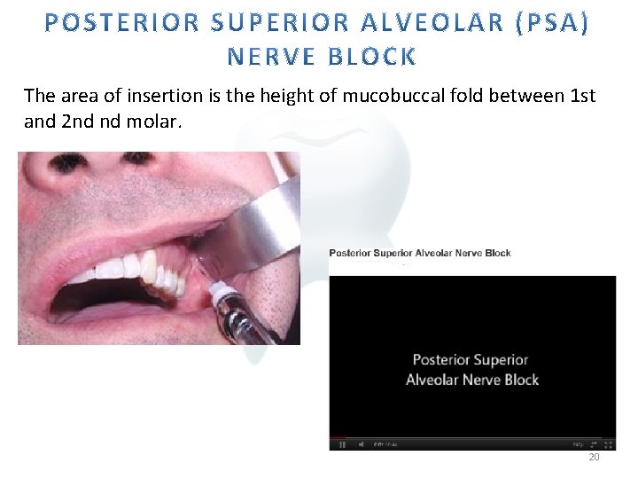 The area of insertion is the height of mucobuccal fold between 1 st and