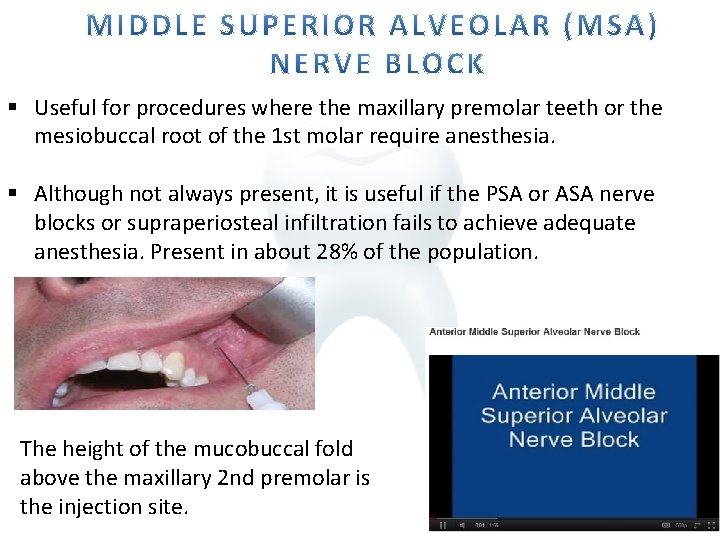§ Useful for procedures where the maxillary premolar teeth or the mesiobuccal root of