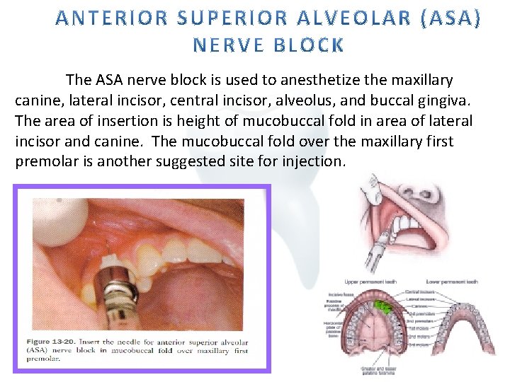 The ASA nerve block is used to anesthetize the maxillary canine, lateral incisor, central