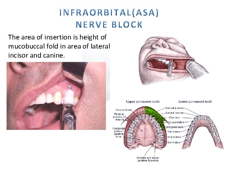 The area of insertion is height of mucobuccal fold in area of lateral incisor