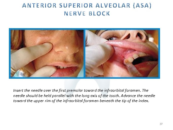 Insert the needle over the first premolar toward the infraorbital foramen. The needle should