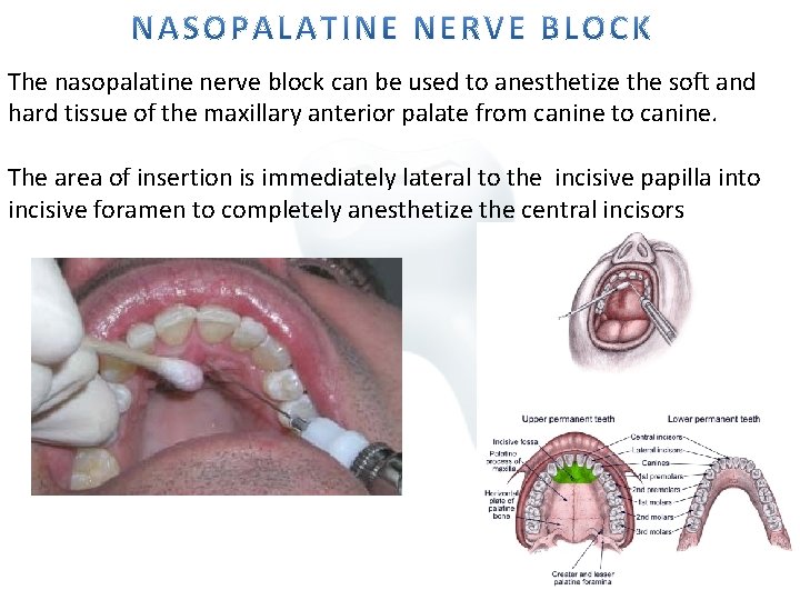 The nasopalatine nerve block can be used to anesthetize the soft and hard tissue