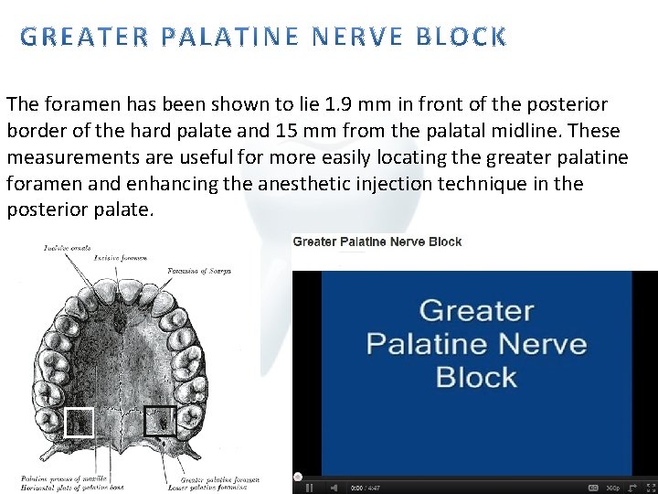The foramen has been shown to lie 1. 9 mm in front of the
