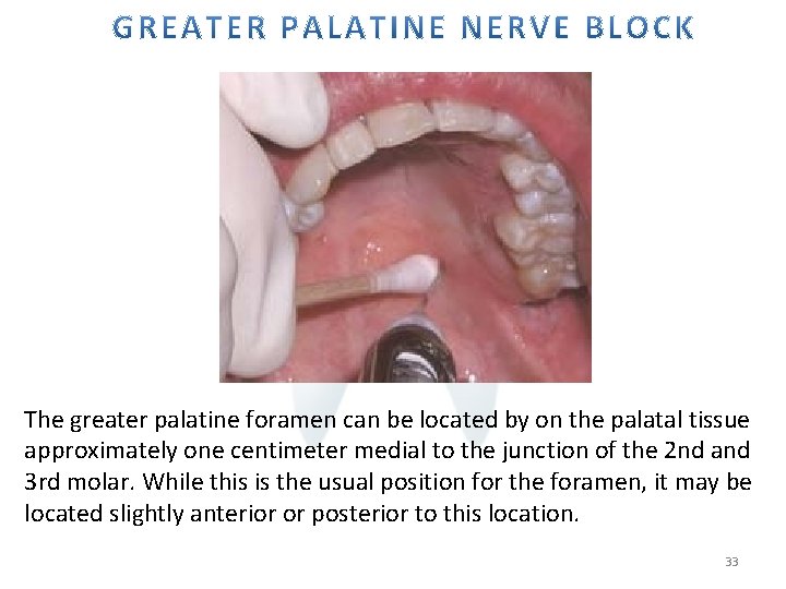 The greater palatine foramen can be located by on the palatal tissue approximately
